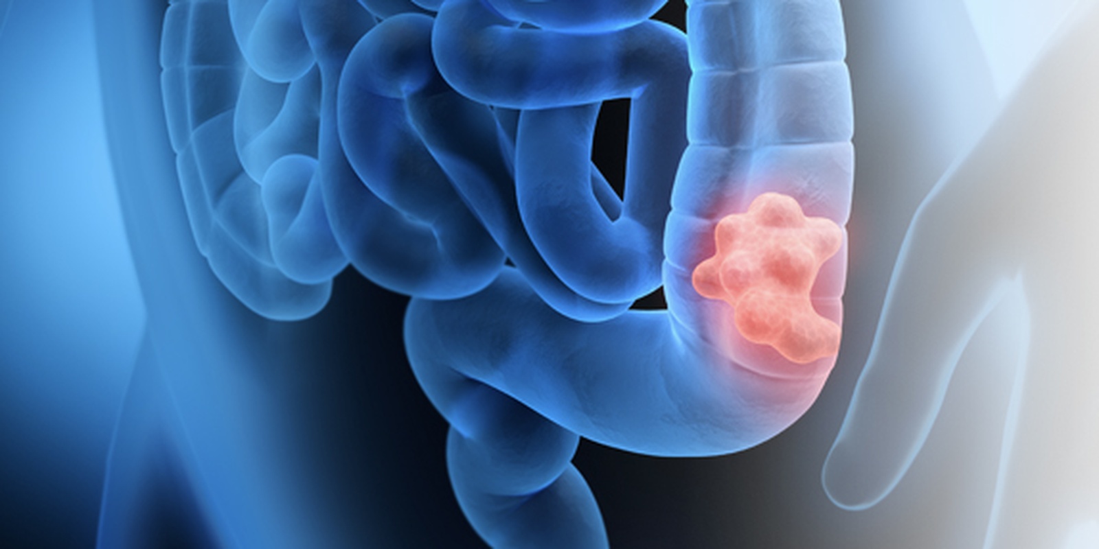 Colorectal Cancer