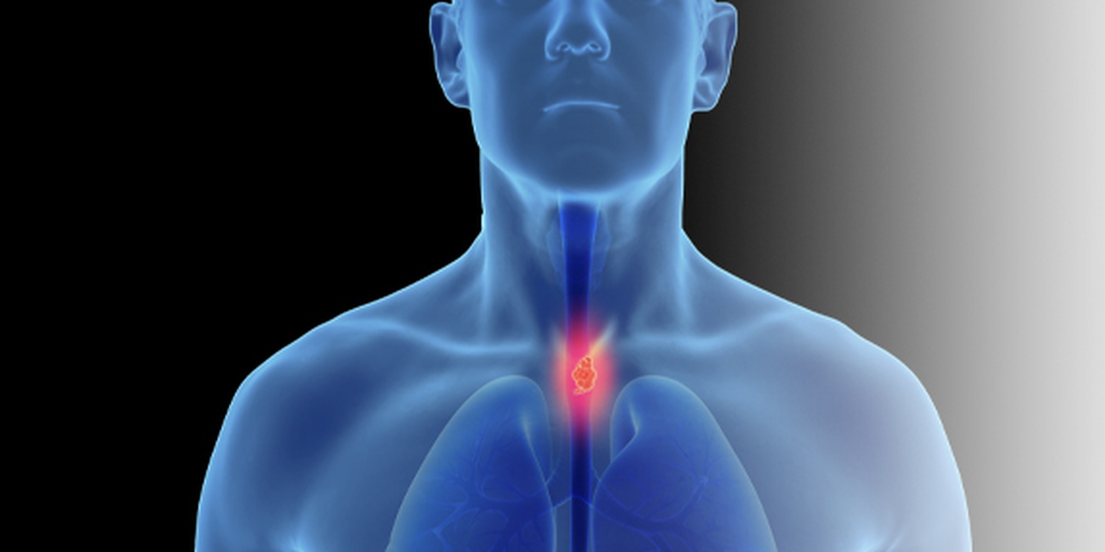 Esophageal Cancer