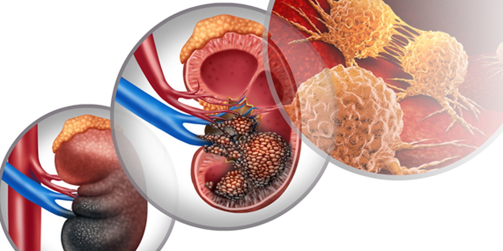 Kidney Cancer