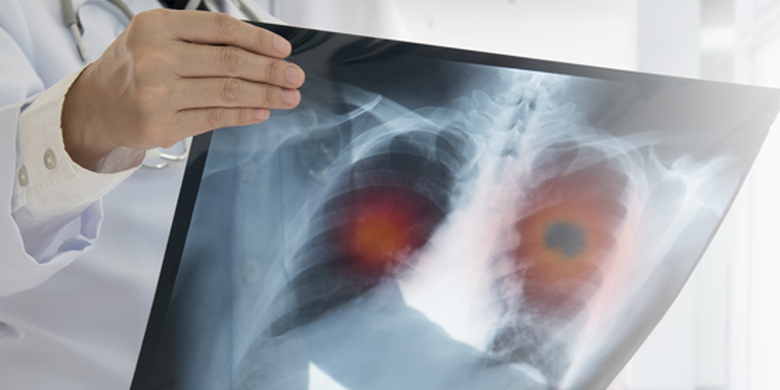 Lung Cancer