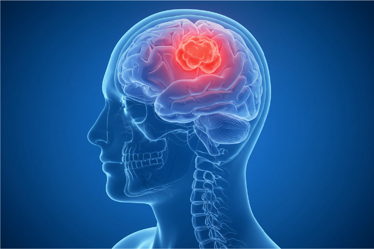 Brain Cancer
