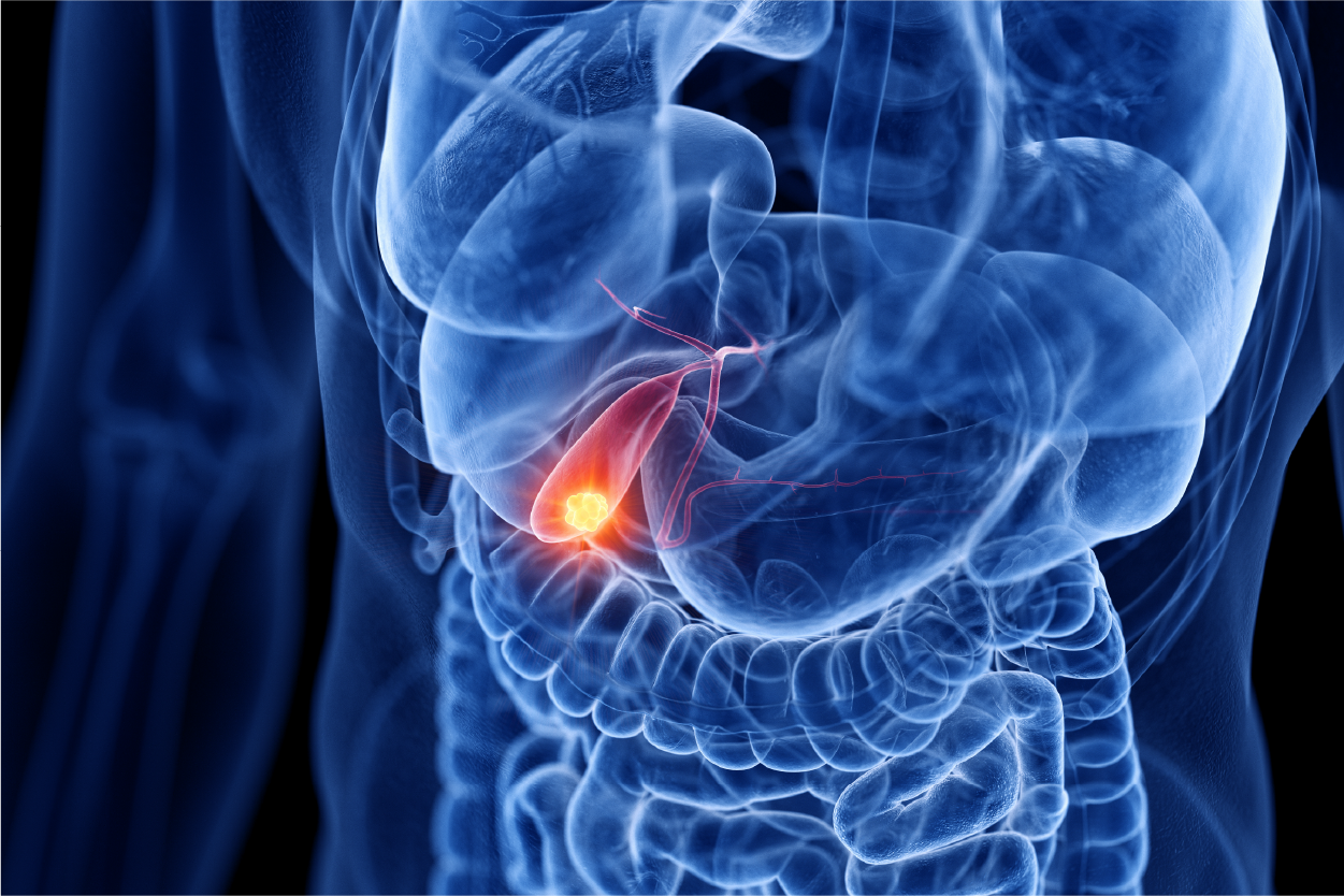 Gallbladder Cancer