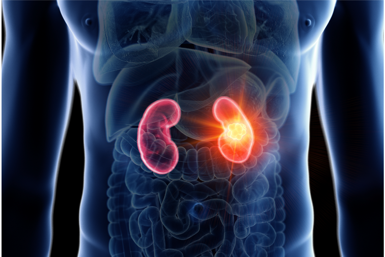 Kidney Cancer