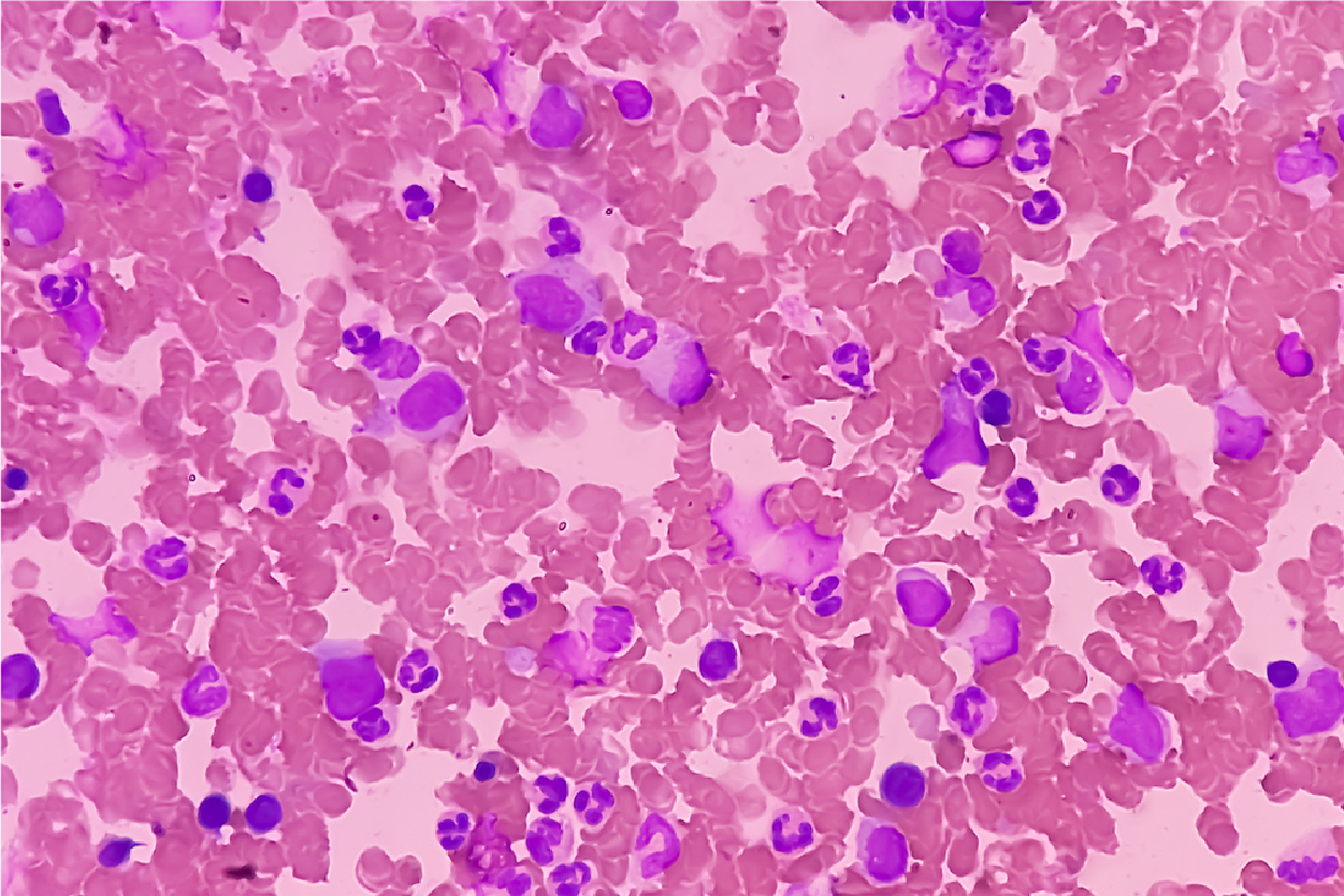 Myeloproliferative Neoplasms