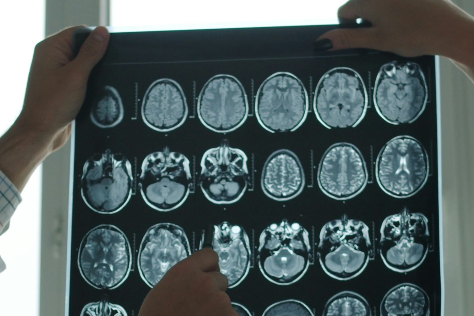 Brain Cancer
